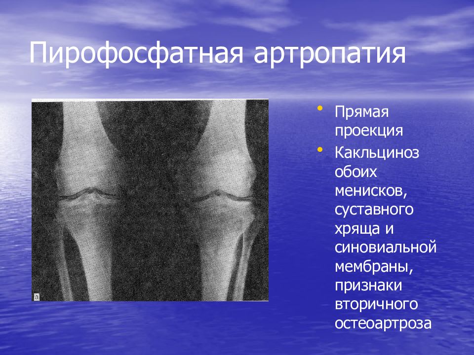 Пирофосфатная артропатия