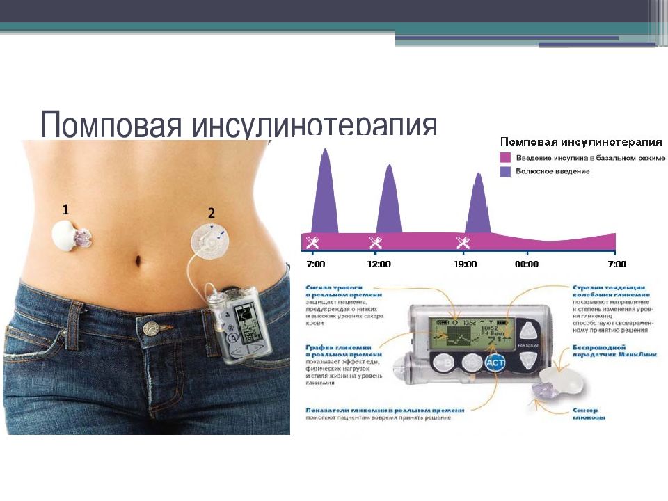 Помповая инсулинотерапия презентация