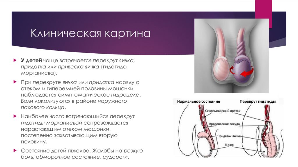 Перекрут яичка карта вызова