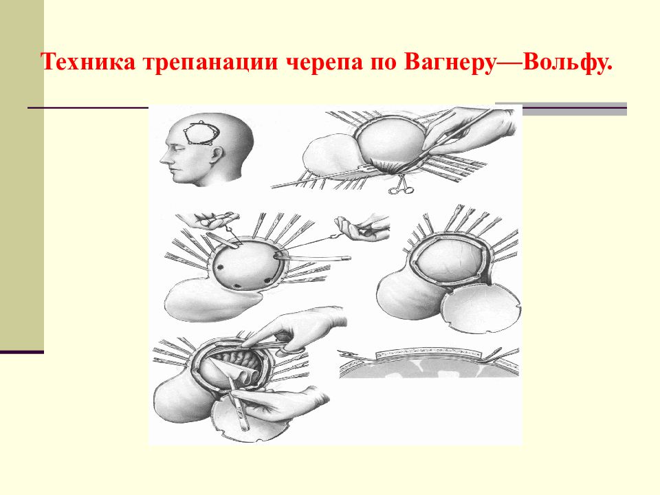 Трепанация черепа презентация