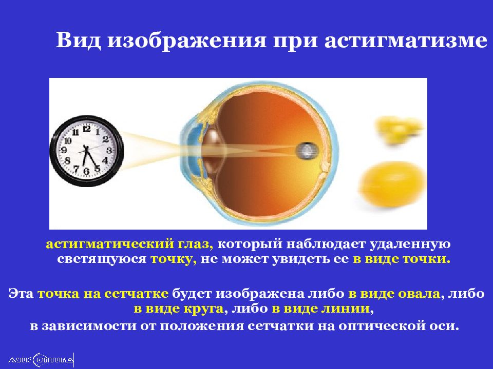 Астигматизм. При астигматизме. Капли для глаз при астигматизме. Астигматическая точка.