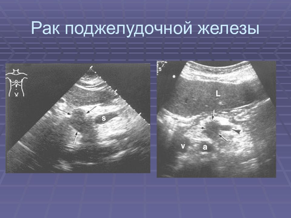 Рак поджелудочной железы клиническая картина