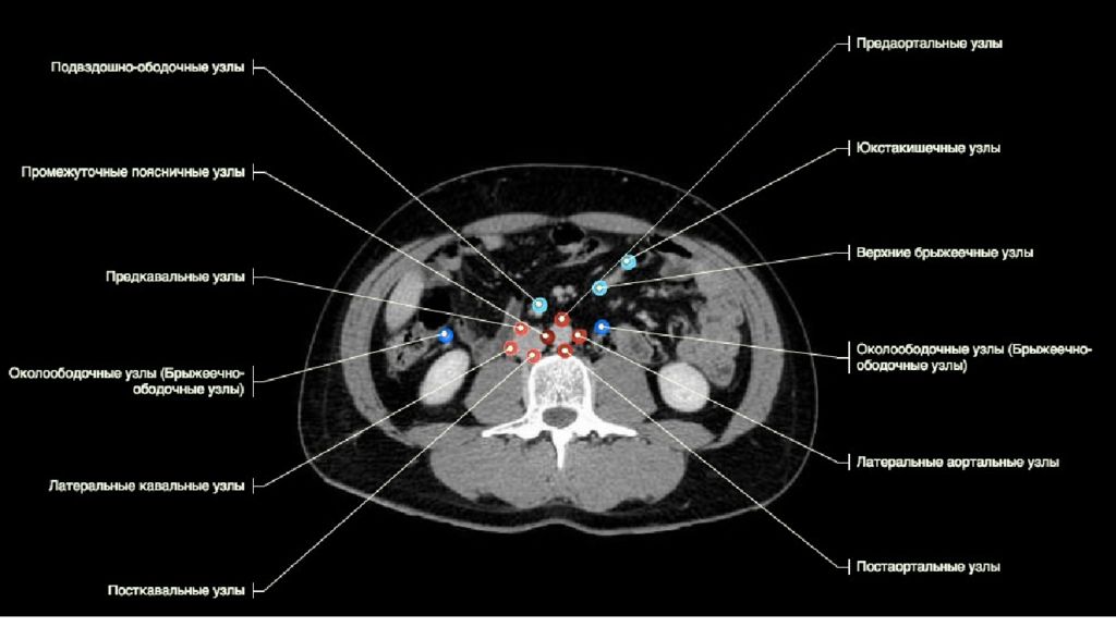 Забрюшинные лимфатические узлы. Забрюшинные лимфатические узлы на кт. Группы лимфатических узлов брюшной полости кт. Лимфатические узлы брюшной полости кт анатомия. Лимфатические узлы брюшной полости кт.