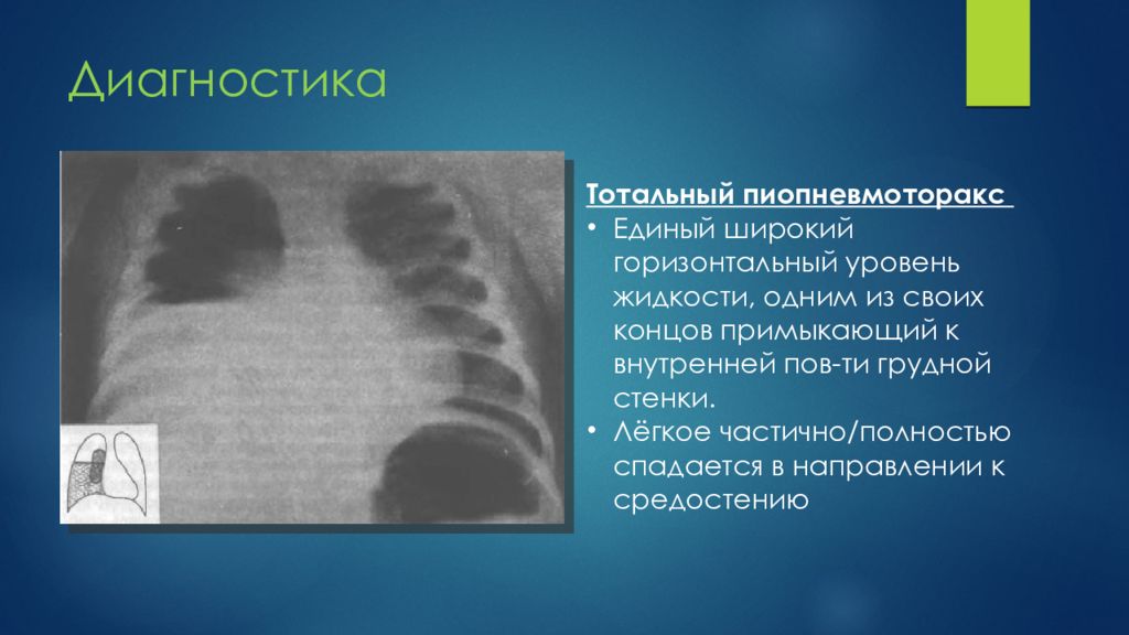 Горизонтальные уровни жидкости. Пиопневмоторакс рентгенограмма. Горизонтальный уровень жидкости в легких. Горизонтальный уровень жидкости на рентгене. Напряженный пиопневмоторакс.