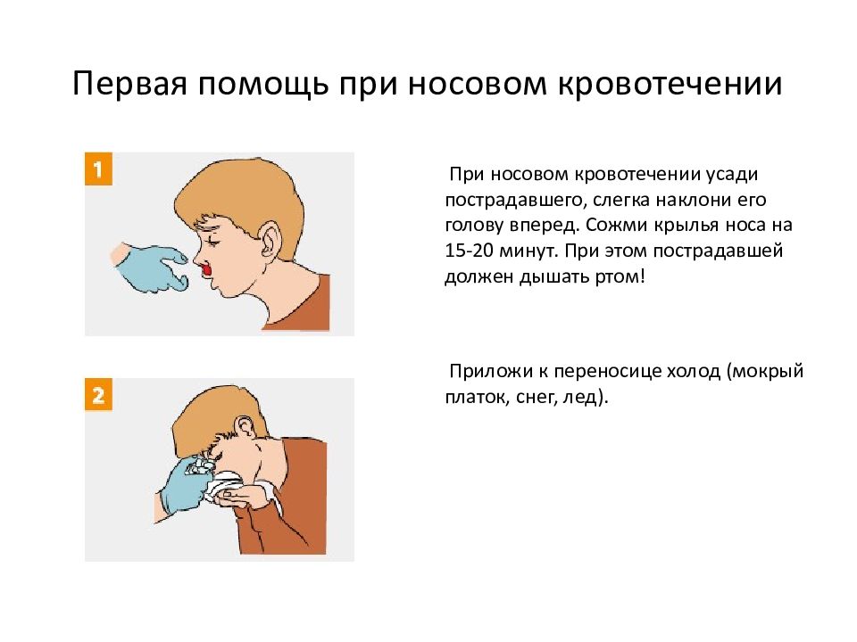 С носовым кровотечением следует. ПМП при носовом кровотечении. ПМП при кровотечении из носа. Как оказать первую медицинскую помощь при кровотечении из носа. При носовом кровотечении больной должен лежать.