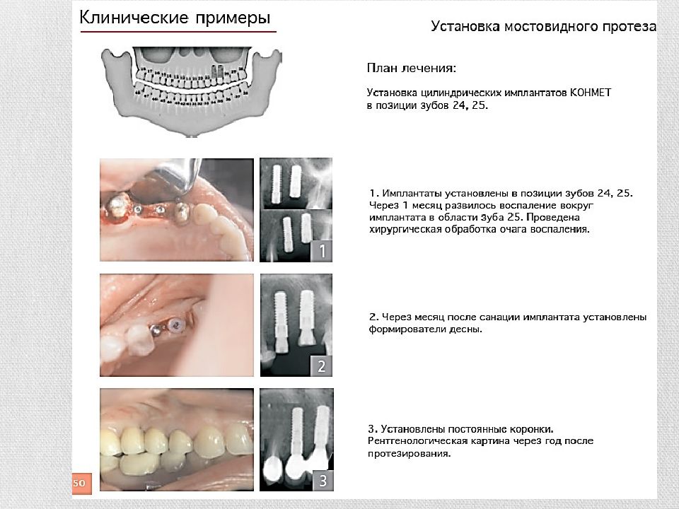 Противопоказания для имплантов. Двухэтапная дентальная имплантация. Хирургический этап дентальной имплантации. Этапы дентальной имплантации. Хирургические этапы при дентальной имплантации.