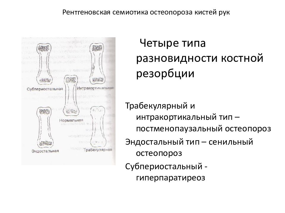 Анализ кости на остеопороз