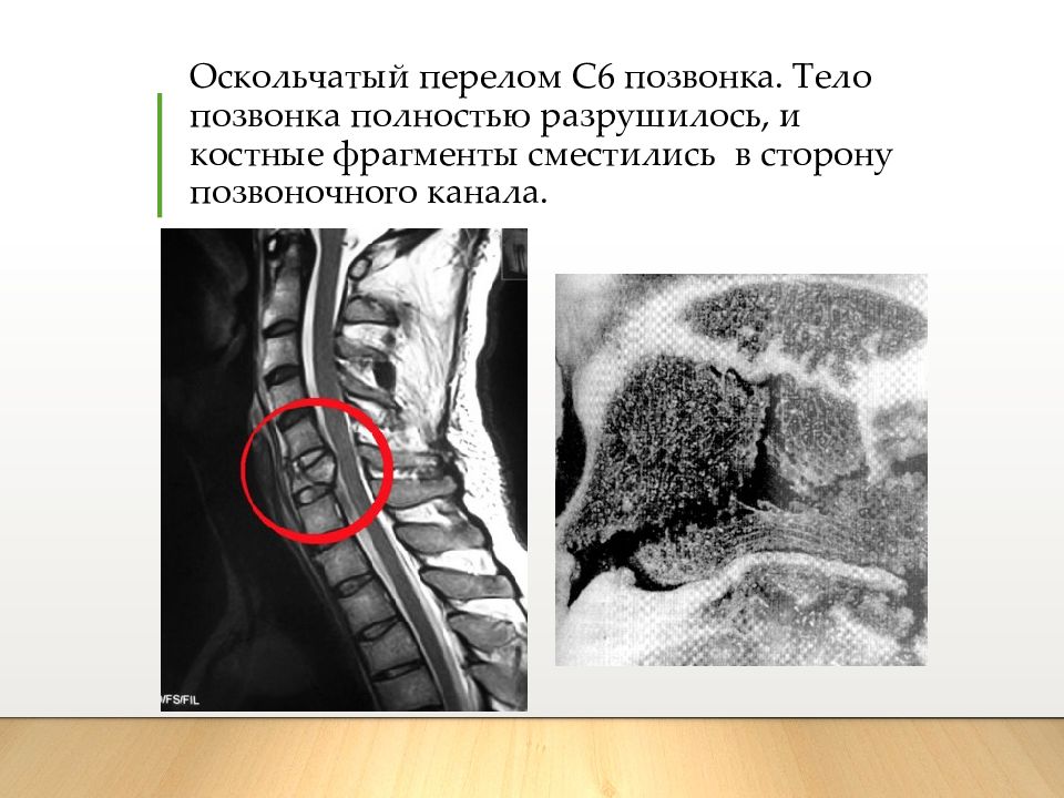 Повреждения шейного отдела позвоночника презентация