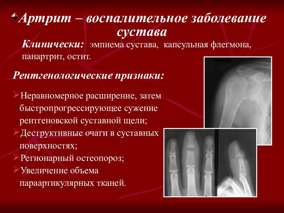 Причина костного заболевания. Рентгенологические синдромы патологии костно-суставного аппарата. Рентгенологические проявления поражений костей и суставов. Рентгенологические стадии ревматоидного артрита рентгенологические. Рентген критерии ревматоидного артрита.