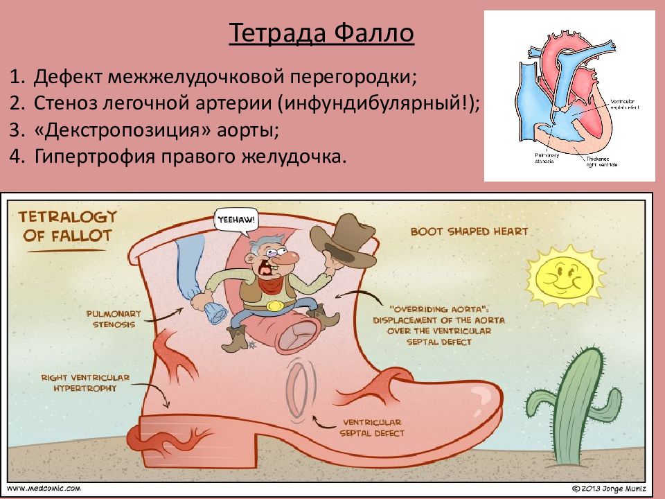 Тетрада фалло презентация педиатрия