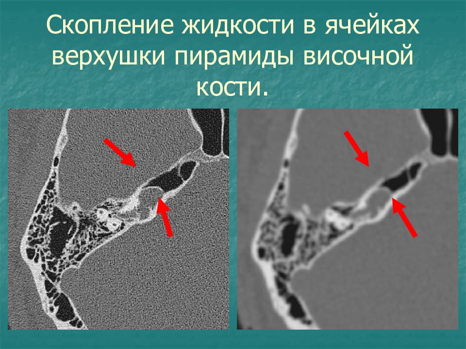 Пирамида височной кости. Пирамида височной кости на кт. Перелом пирамиды височной кости кт. Пирамиды височных костей. Верхушка пирамиды височной кости.