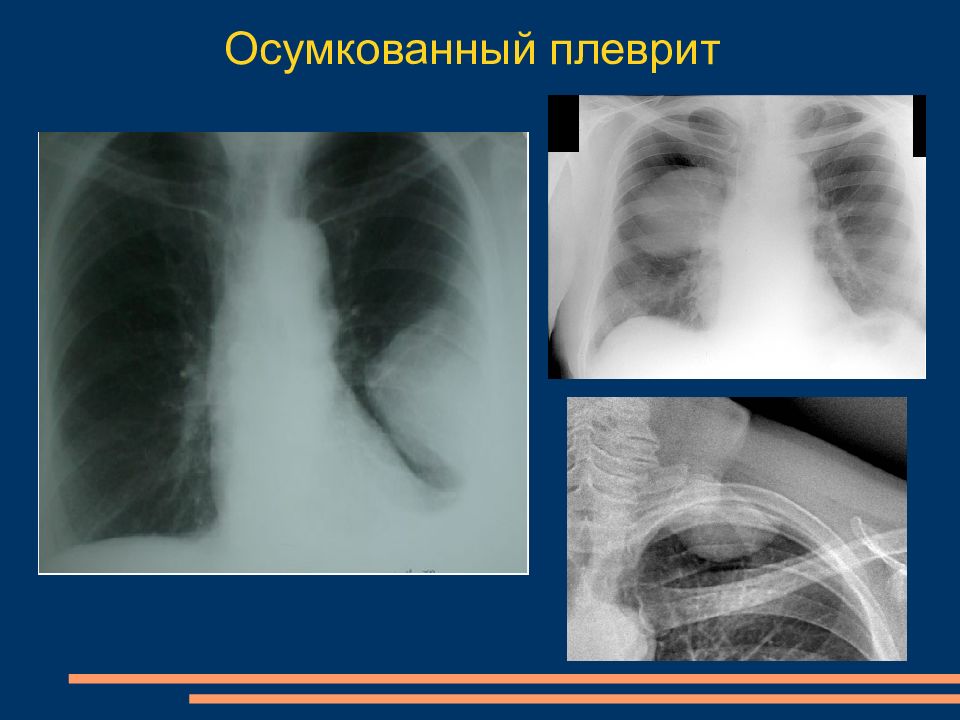 Легкие справа. Осумкованный плеврит рентген. Осумкованный междолевой плеврит рентген. Осумкованный плеврит справа рентген. Осумкованный гидроторакс.