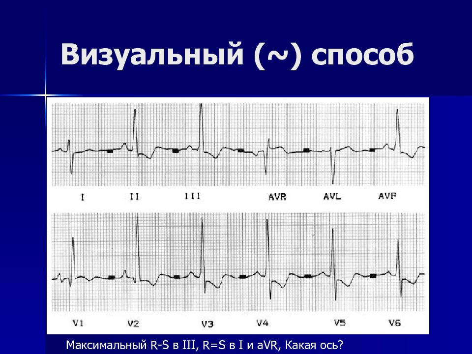 Визуальный метод. Зубец q в AVR И AVL. В iiiотведении r=s какая ось. Макс r-r норма. З.Q В AVL.