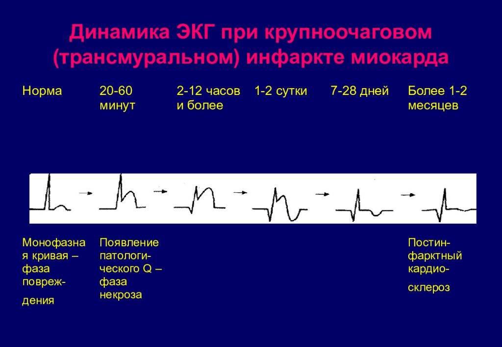 Признаки трансмурального инфаркта. ЭКГ динамика трансмуральный инфаркт. Наиболее характерный ЭКГ-признак крупноочагового инфаркта миокарда. Основным ЭКГ-признаком трансмурального инфаркта миокарда является. ЭКГ при острейшей стадии инфаркта миокарда.