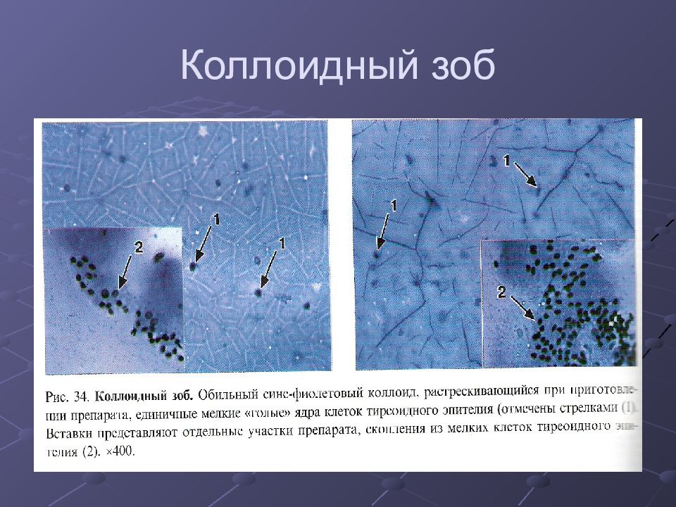 Что такое цитологическая картина коллоидного узла