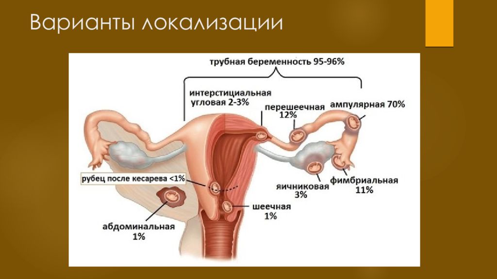 Внематочная беременность картинки для презентации