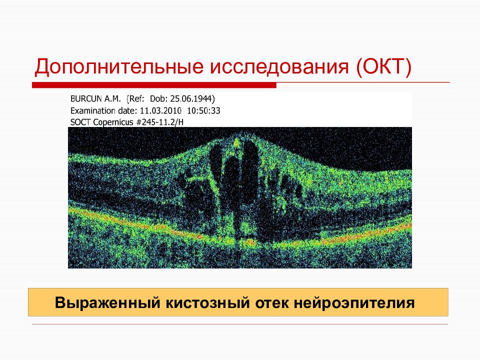 Обследование окт. Оптическая когерентная томография. Нейроэпителий сетчатки это. Оптическая когерентная томография заключение. Изучение окт.