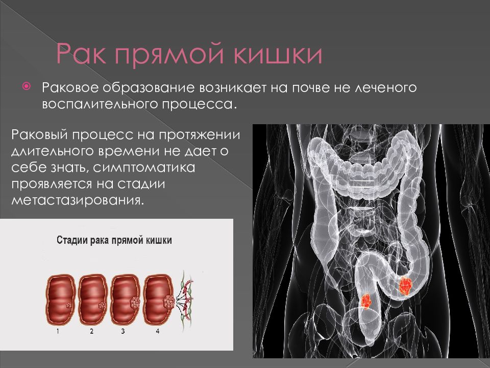 Может ли прямая кишка. Хирургические заболевания и травмы прямой кишки. Злокачественное новообразование прямой кишки.