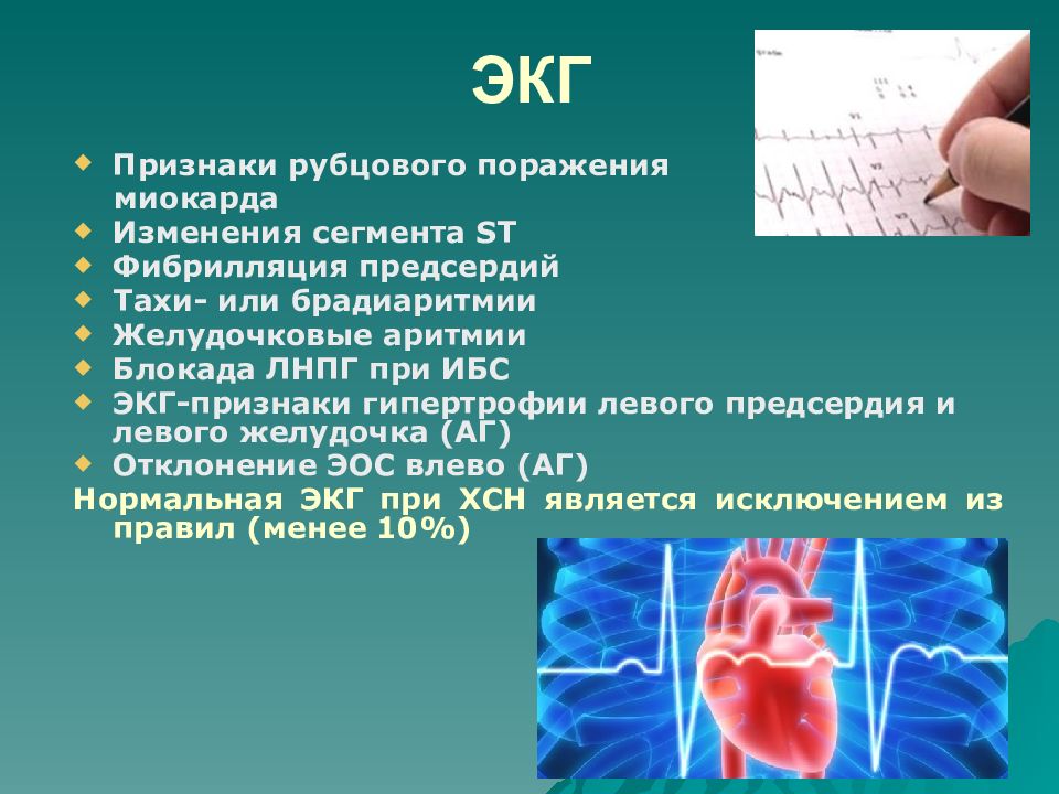 Изменения миокарда предсердий. Изменения на ЭКГ при сердечной недостаточности. ЭКГ при хронической коронарной недостаточности. ЭКГ хронической сердечной недостаточности. Признаки ХСН на ЭКГ.