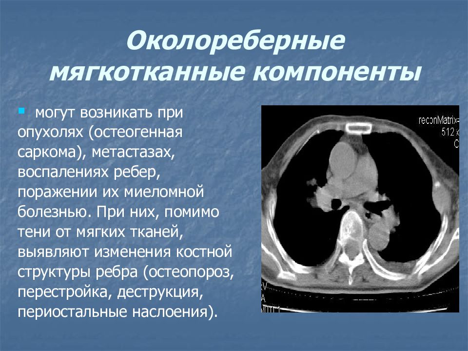 Мягкотканное образование в легком на кт. Миелома с мягкотканным компонентом.