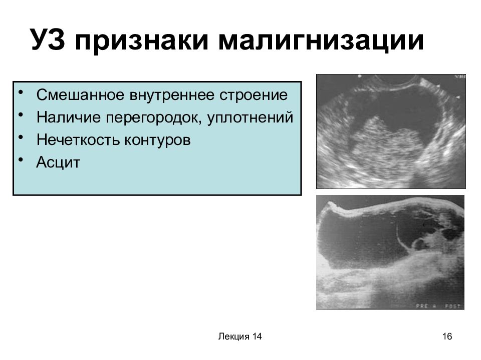 Первый признак рак яичника. Малигнизация опухоли яичника. Признаки малигнизации опухоли. Признаки малигнизации опухоли яичника.