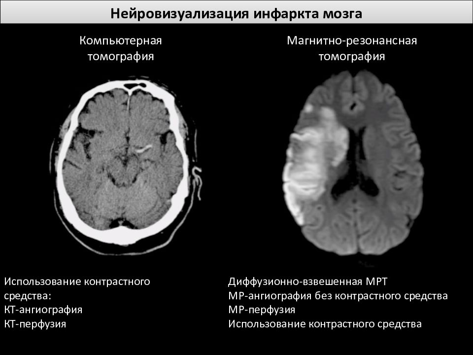 Последствия инфаркта мозга