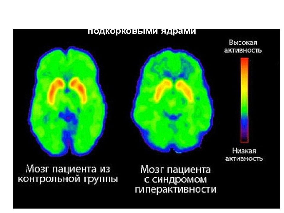 Гиперактивность мозга. Активность мозга при СДВГ. Мозг гиперактивного ребенка. Мозг детей при СДВГ. СДВГ И гиперактивность мозг.