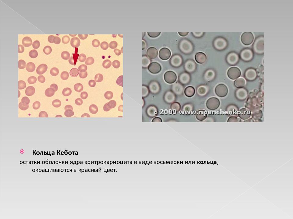 Кольца кебота анемия