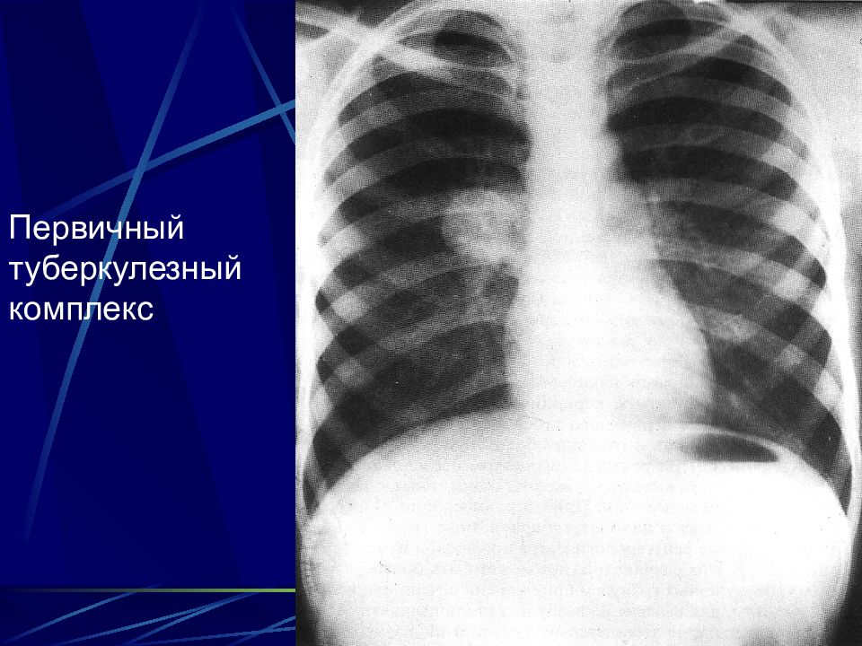 Врожденный туберкулез. Первичный очаг туберкулеза рентген. Пневмоническая стадия первичного туберкулезного комплекса. Первичный туберкулез комплекс рентген. Первичный туберкулез рентгенограмма.