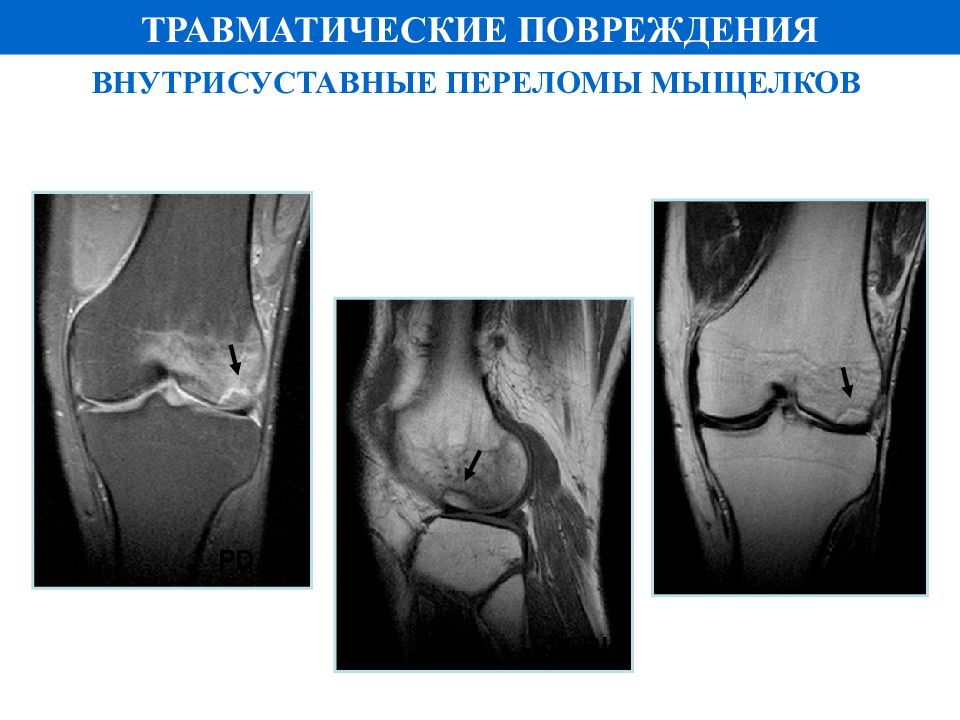 Повреждения мыщелка