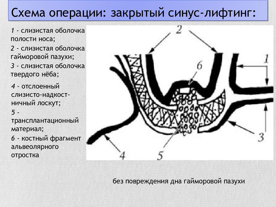 Синус операции. Лифтинг гайморовой пазухи. Синус-лифтинг гайморова пазуха. Открытый синус лифтинг схема. Открытый и закрытый синус лифтинг.