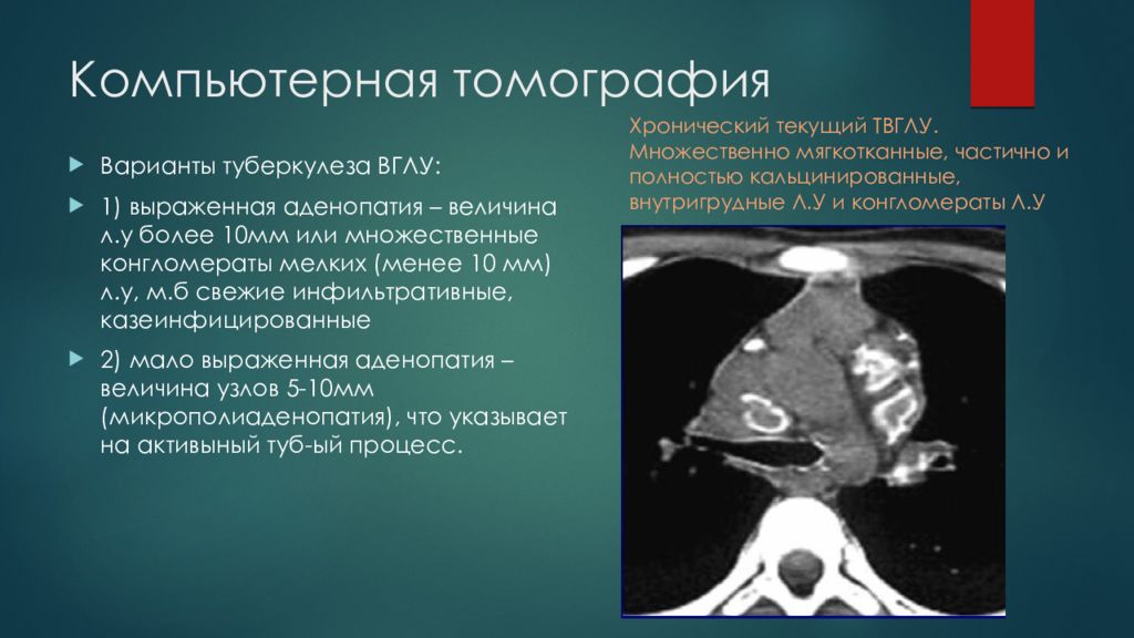 Аденопатия. Туберкулез внутригрудных лимфатических узлов кт. Компьютерная томография туберкулеза легких. Кт при туберкулезе легких.