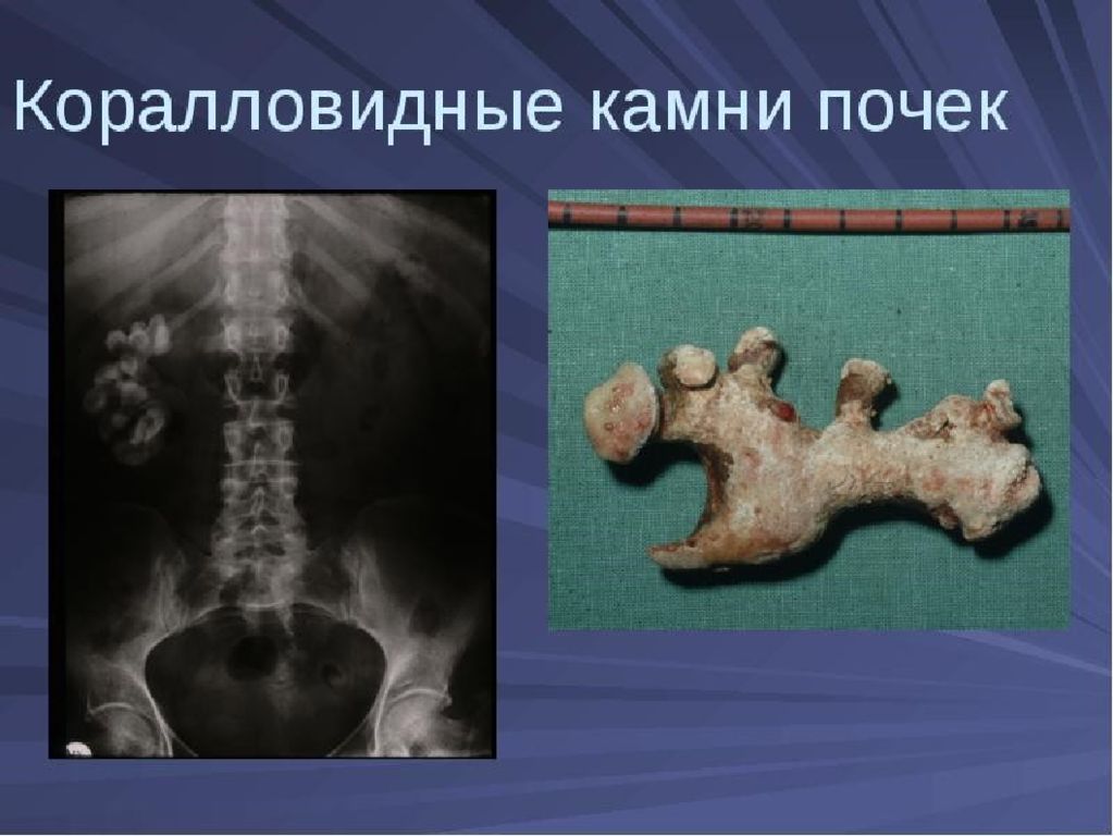 Нефролитиаз это. Коралловидный нефролитиаз. Мочекаменная болезнь коралловидные камни. Коралловидный конкремент в почке. Коралловидный нефролитиаз рентген.