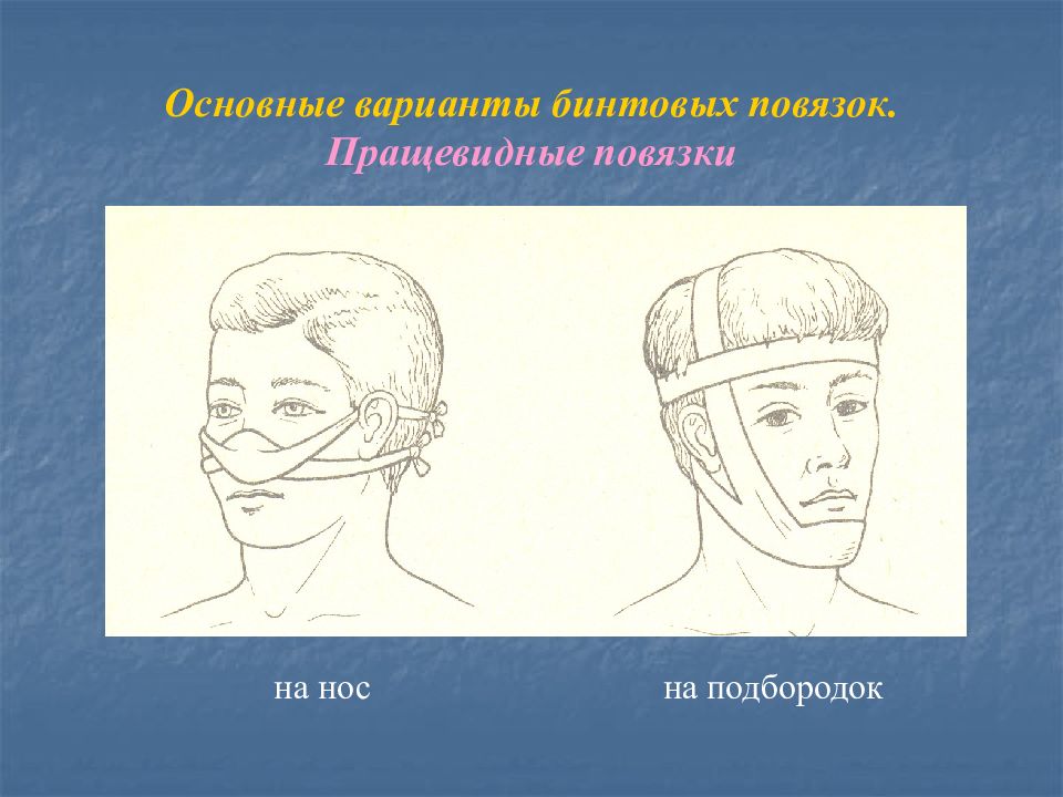 Пращевидная повязка. Пращевидная повязка на нос. Пращевидная повязка на нос и подбородок. Наложение пращевидной повязки на нос алгоритм. Наложить повязку на нос.