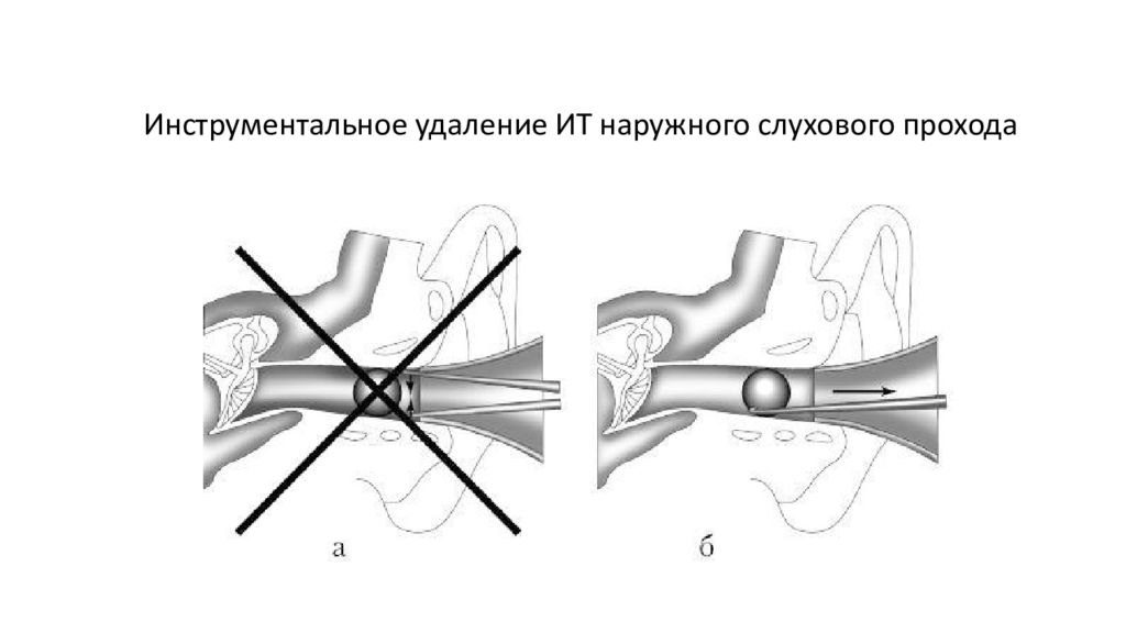 Удаление инородного. Инородные тела наружного слухового прохода. Инородные тела ЛОР органов. Резекция наружного слухового прохода. Удаление инородного тела наружного слухового прохода.