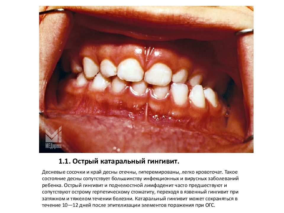 1.1. Острый катаральный гингивит.
