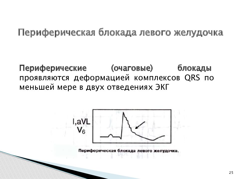 Блокада левого желудочка. Виды периферических блокад.