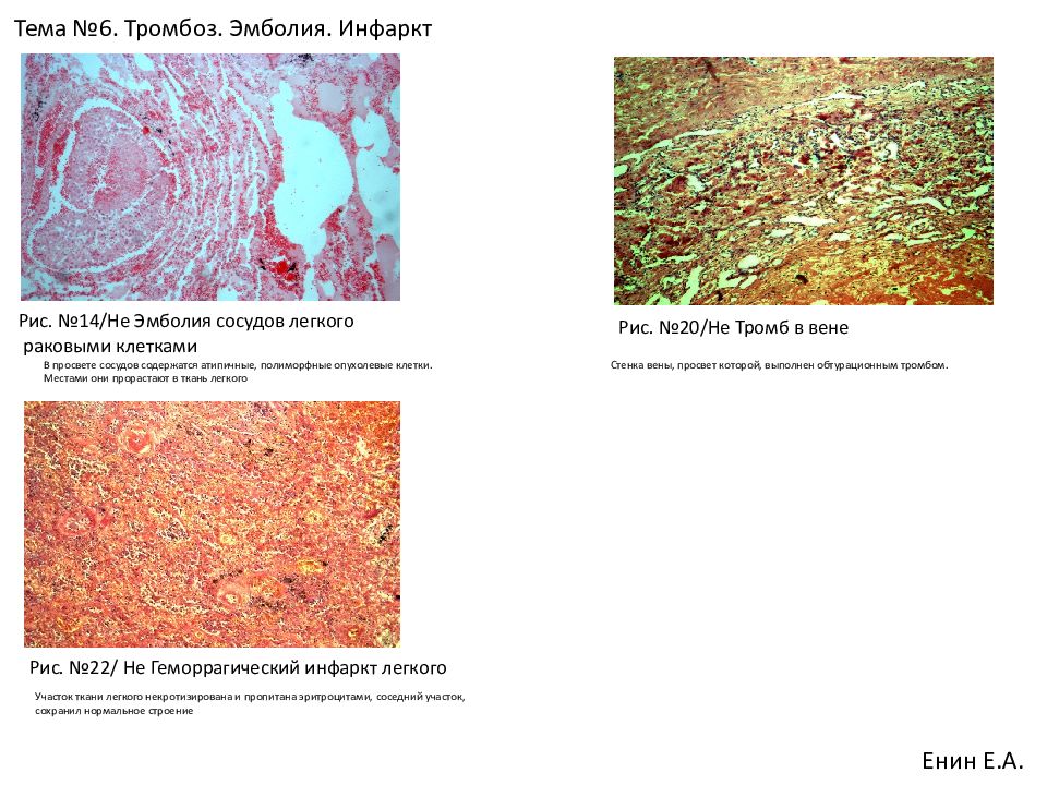 Инфаркт легкого. Микробная эмболия геморрагический инфаркт легкого при септикопиемии. Микробный эмбол в сосуде печени микропрепарат. Эмболия сосудов легкого раковыми клетками. Эмболия опухолевыми клетками микропрепарат.