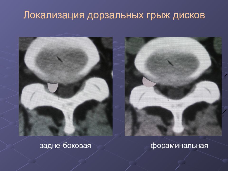 Парамедианная грыжа позвоночника. Фораминальная грыжа межпозвонкового диска. Фораминальная протрузия кт. Фораминальная грыжа диска кт. Фораминальная грыжа на кт.