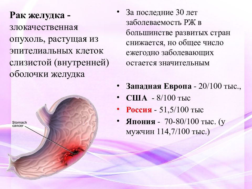 Желудок какой рак. Раковые заболевания желудка. Злокачественная опухоль желудка. Степени онкологии желудка.