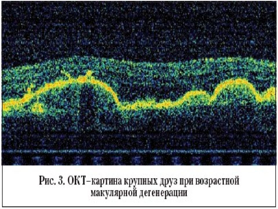 Картинки кератоконуса при оптической когерентной томографии