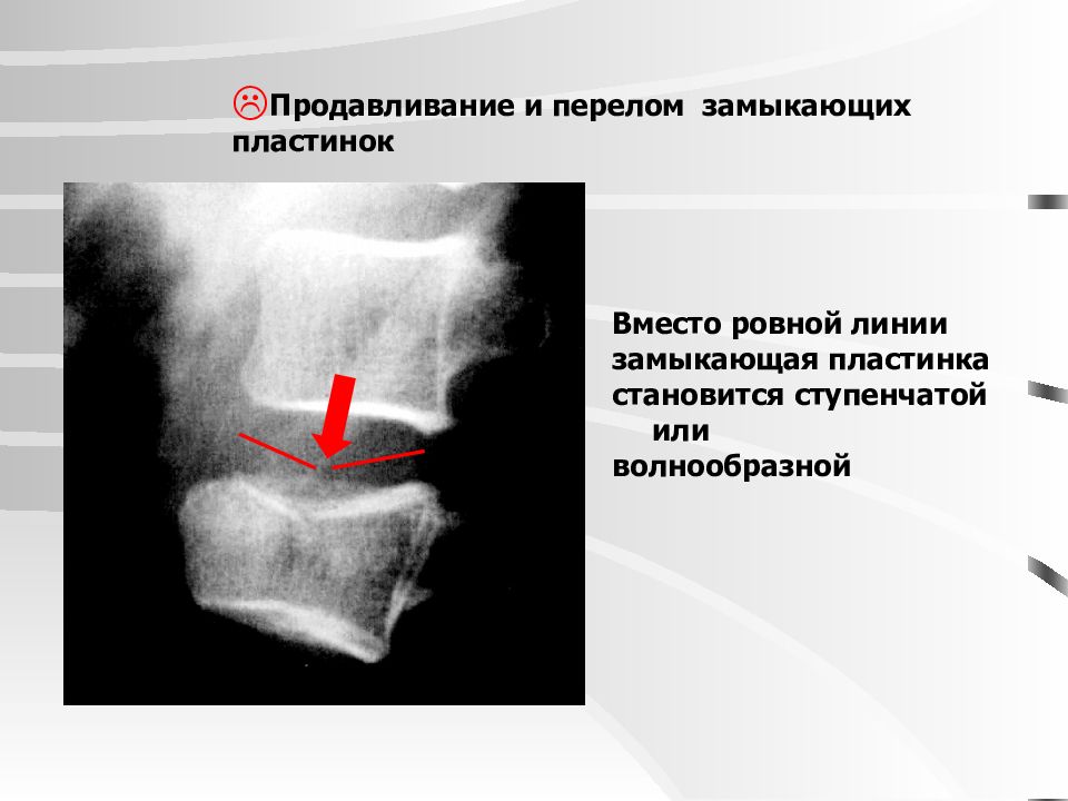 Пластинка позвонка. Замыкательные пластины позвонка. Замыкательные пластинки неровные. Замыкающая пластинка позвонка. Замыкательная пластинка тела позвонка.