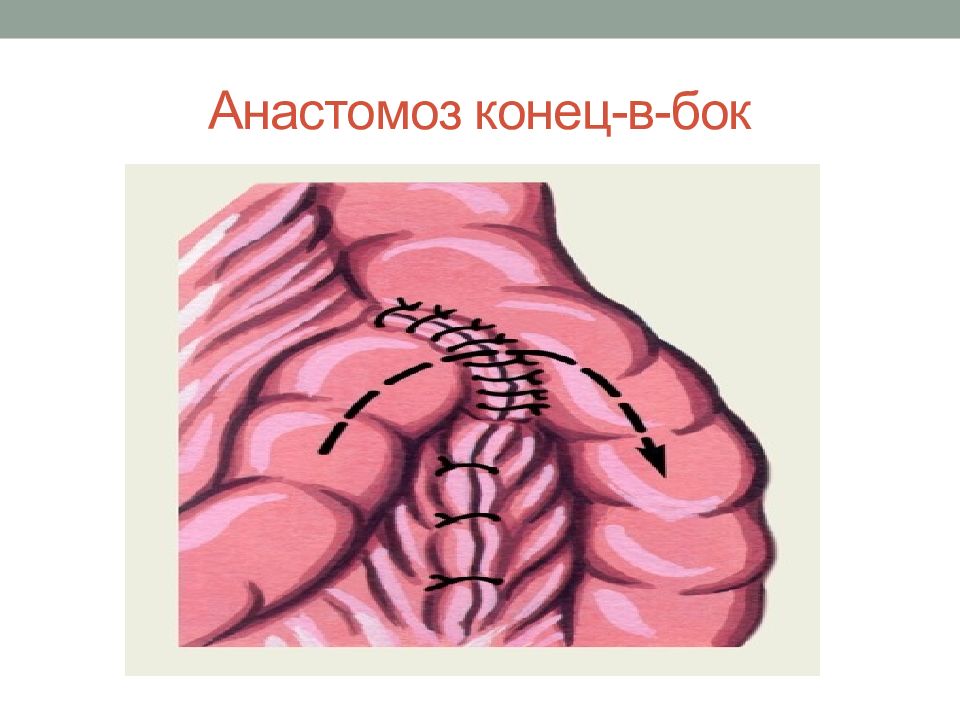 Кишечные анастомозы. Анастомоз тонкой кишки. Анастомоз тонкого кишечника. Изоперистальтический анастомоз.