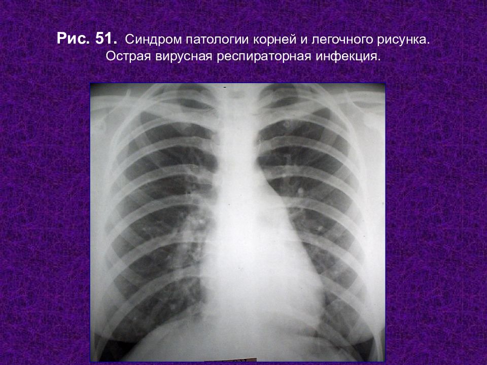 Патология легочного рисунка на рентгенограмме