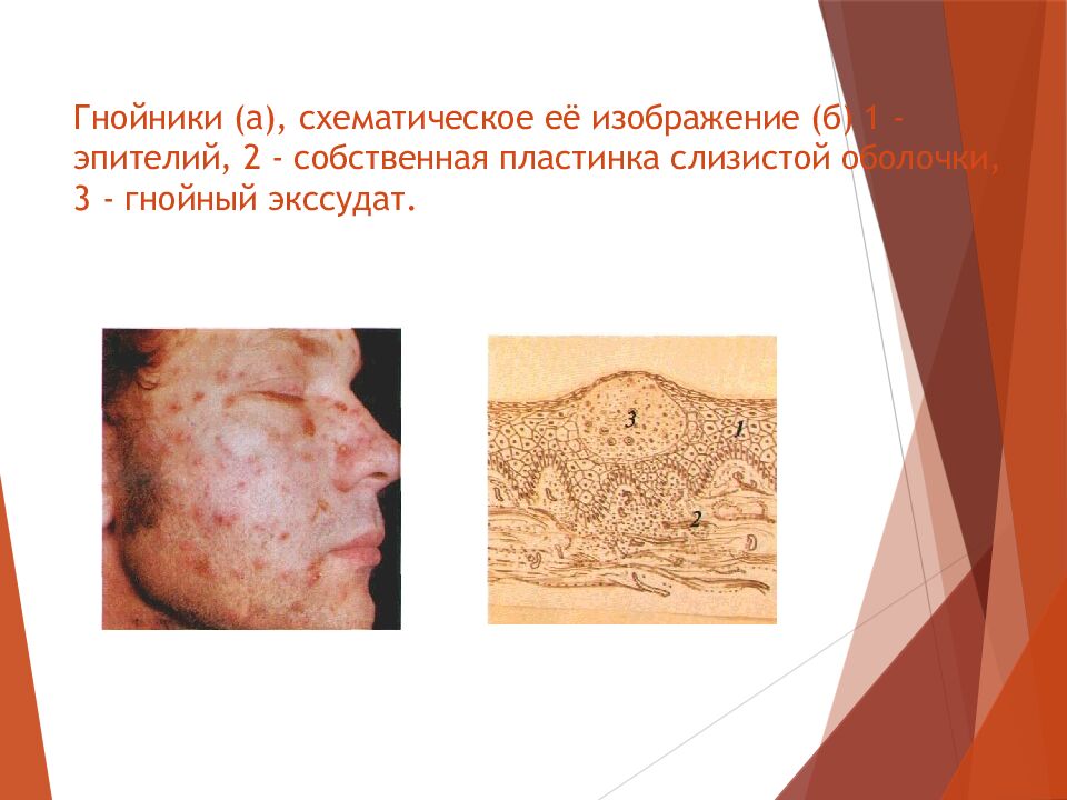 Гнойники (а), схематическое её изображение (б) 1 - эпителий, 2 - собственная пластинка слизистой оболочки, 3 - гнойный экссудат.