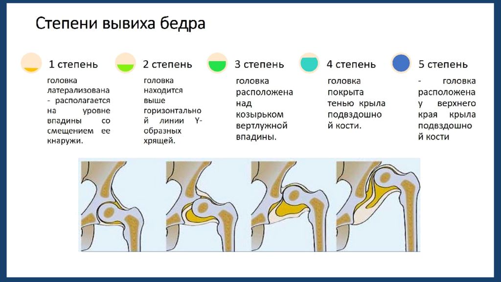 Врожденный вывих бедра презентация