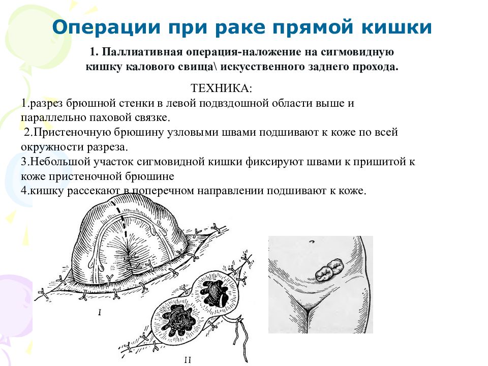 Презентация операции на прямой кишке