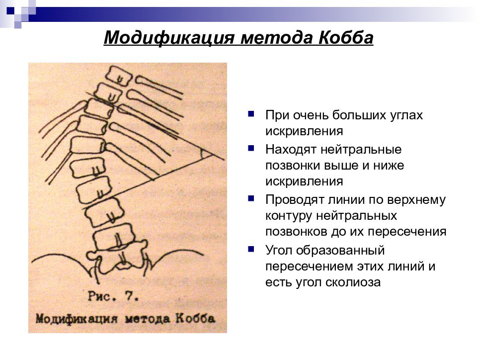 Модификация методик. Рентгенодиагностика сколиоза по коббу. Метод Кобба. Методика Кобба. Метод Кобба сколиоз.