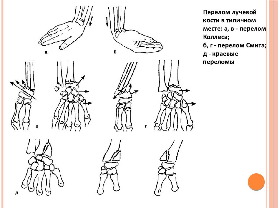 Иммобилизация перелома лучевой кости в типичном месте. Перелом лучевой кости в типичном месте. Типичные места переломов верхних конечностей и плечевого пояса. Переломы лучевой кости в типичном месте типа коллеса и Смита. Типичные места переломов костей плечевого пояса.