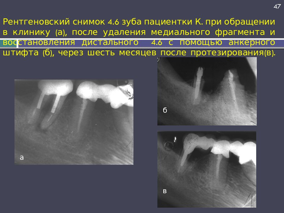 Рентгеновский снимок 4.6 зуба пациентки К. при обращении в клинику (а), после удаления медиального фрагмента и восстановления дистального 4.6 с помощью